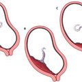 placenta_previa.jpg
