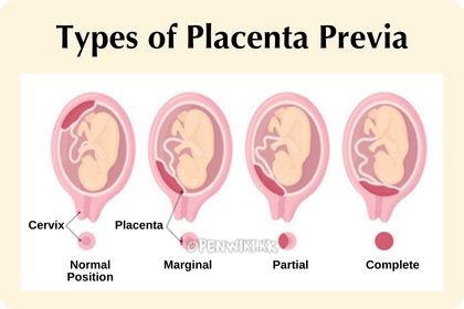 placenta_previa_4604.png