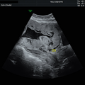 placenta_previa_5442.png