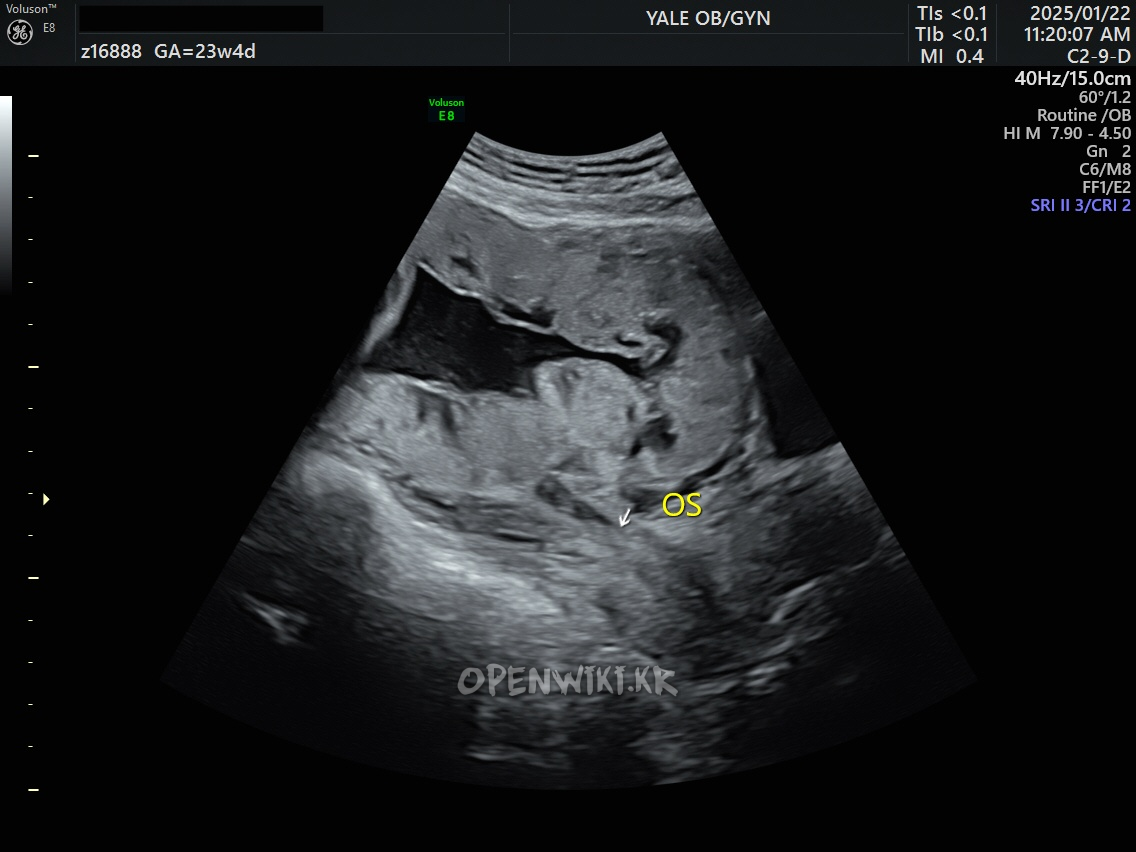placenta_previa_5442.png