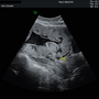 placenta_previa_5442.png
