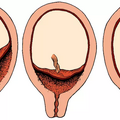 placenta_previa_5649.png