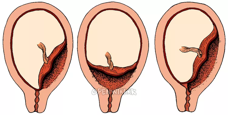 placenta_previa_5649.png