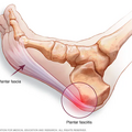 plantar_fasciitis_2936.png