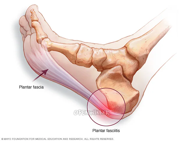 plantar_fasciitis_2936.png
