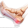 plantar_fasciitis_2936.png