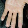 pompholyx020115-2.jpg