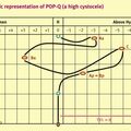 pop-q_visual.jpg
