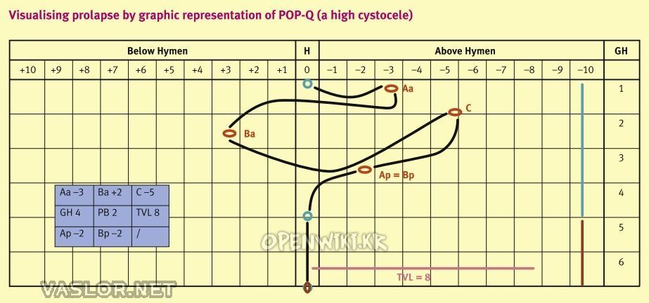 pop-q_visual.jpg