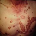 porokeratosis4-458.jpg
