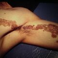 porokeratosis4-485.jpg
