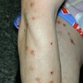 prurigo020326-3.jpg