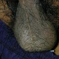 pruritusscroti010329.jpg