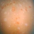 psoriasis9-833.jpg