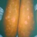 psoriasis9-834.jpg