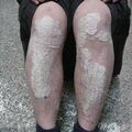 psoriasis_knee010205.jpg