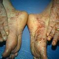 psoriasis_pustluar3-478.jpg