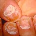 psoriasisnail1.jpg