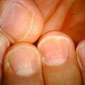 psoriasisnail2.jpg