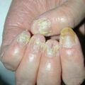 pustularpsoriasis020516-2.jpg