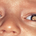 retinoblastoma_4102.png
