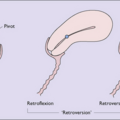 retroverted_uterus_1641.png