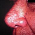 rhinophyma2000-113.jpg