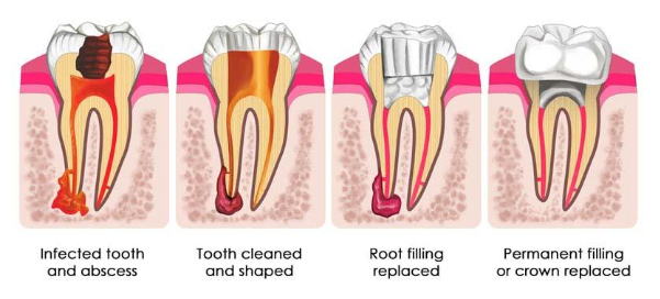 root_canal_treatment_2755.png