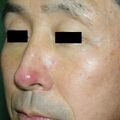 rosacea020116.jpg