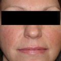 rosacea_v_l0118002346.png