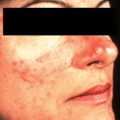 rosacea_v_l0118002405.png