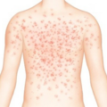 rubella_0123143550.png