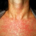 rubella_0123143609.png