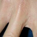 scabies020103.jpg