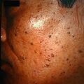 seborrheickeratosis1.jpg