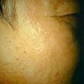 seborrheickeratosis3-1123.jpg