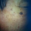 seborrheickeratosis3-348.jpg