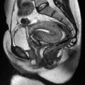 skene_duct_cyst.jpg