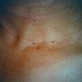 skintag9-578.jpg