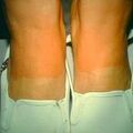solarurticaria3-749.jpg