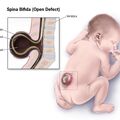 spina_bifida.jpg