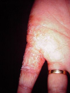 sporotrichosis370.jpg