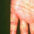 sporotrichosis423.jpg