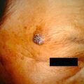 squamouscellca8-228.jpg