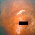 squamouscellca9-544.jpg