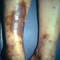 stasisdermatitis3-34.jpg