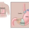 stomach_cancer.jpg
