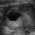 subchorionic_hematoma_1.jpg