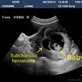 subchorionic_hematoma_2.jpg