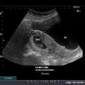 subchorionic_hematoma_3.jpg
